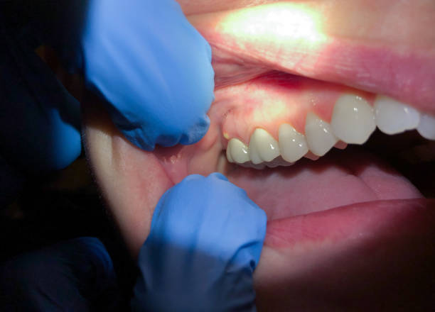 Best Emergency Dentist for Knocked-Out Tooth in Del Rey Oaks, CA